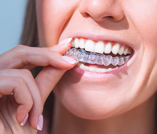 Dream Dental Group | Veneers, Night Guards and SureSmile Aligners