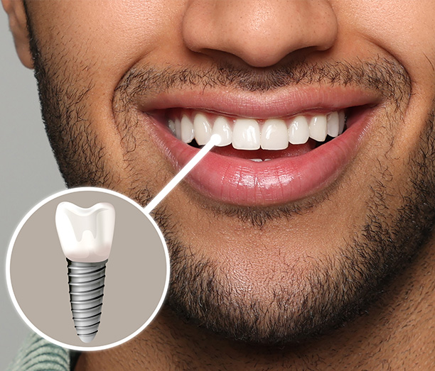 Dream Dental Group | Implant Dentistry, Fluoride Treatment and Snoring Appliances